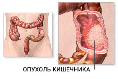 Как вылечить опухоль кишечника? Как вылечить опухоль кишечника?