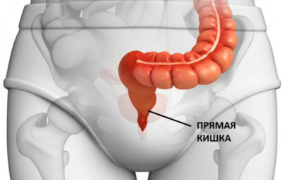 Опухоль в прямой кишке, симптомы и период их проявления Опухоль в прямой кишке, симптомы и период их проявления