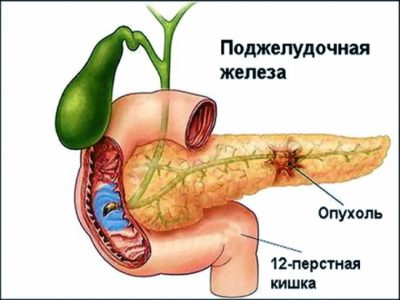 Есть ли шанс полноценно жить при опухоли поджелудочной железы? Есть ли шанс полноценно жить при опухоли поджелудочной железы?