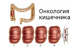 Онкология кишечника – есть ли шанс полноценной жизни? Онкология кишечника – есть ли шанс полноценной жизни?