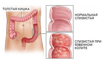 Что такое язвенный колит? Что такое язвенный колит?