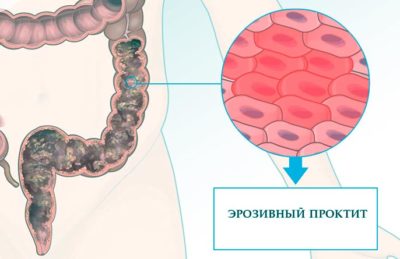 Что такое эрозивный проктит? Что такое эрозивный проктит?