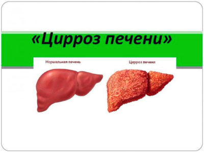 Цирроз печени разной степени: сколько живут? Цирроз печени разной степени: сколько живут?