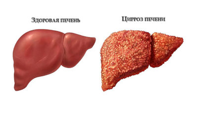 Диагноз цирроз печени Диагноз цирроз печени