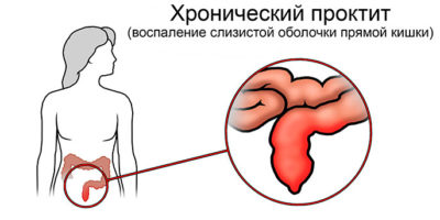 Развитие хронического проктита и его лечение Развитие хронического проктита и его лечение