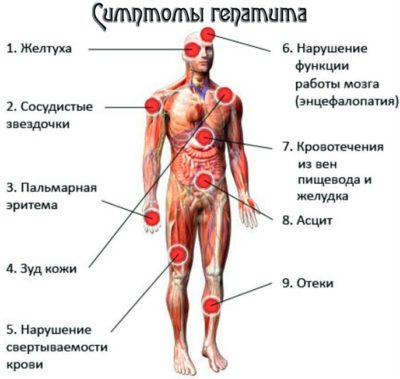 Острый и хронический гепатит С: симптомы и лечение Острый и хронический гепатит С: симптомы и лечение