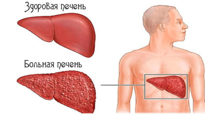 Как лечат хронические воспалительные заболевания печени Как лечат хронические воспалительные заболевания печени