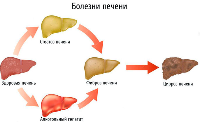 Алкогольный гепатит с переходом в цирроз печени