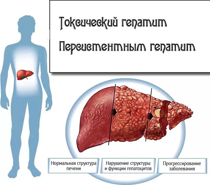Токсический гепатит симптомы