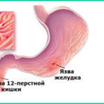 Симптомы и лечение язвы желудка и двенадцатиперстной кишки