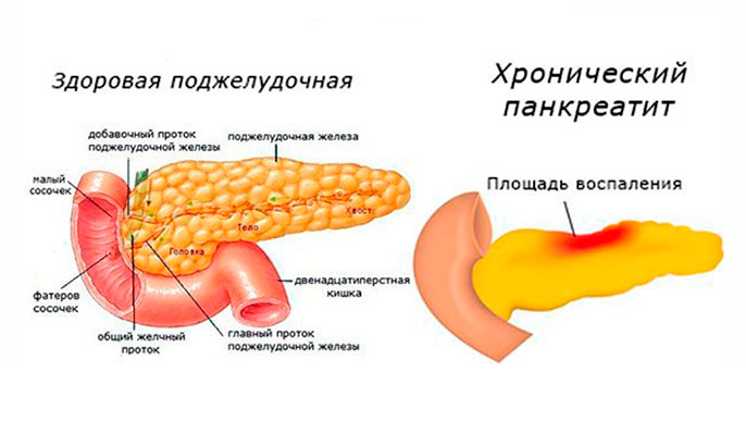 Поджелудочная железа хронический панкреатит