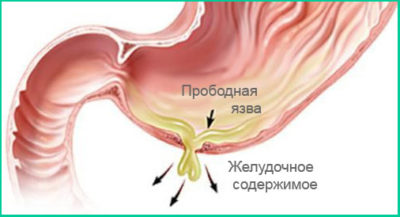 Признаки при язве желудка и двенадцатиперстной кишки в период обострения thumbnail