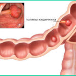 Симптомы и признаки рака кишечника на ранних стадиях