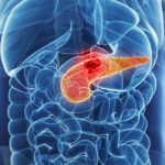 Симптомы и признаки рака поджелудочной железы