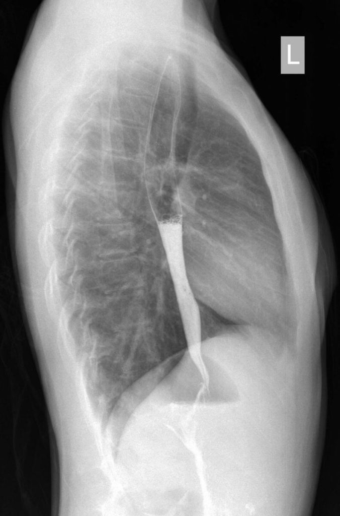 Как проводится рентген желудка с барием