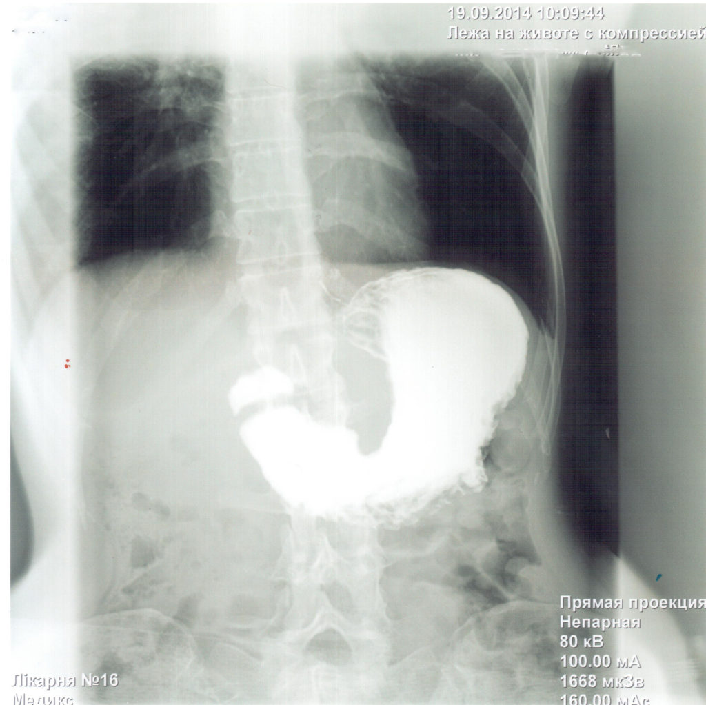 Как проводится рентген желудка с барием