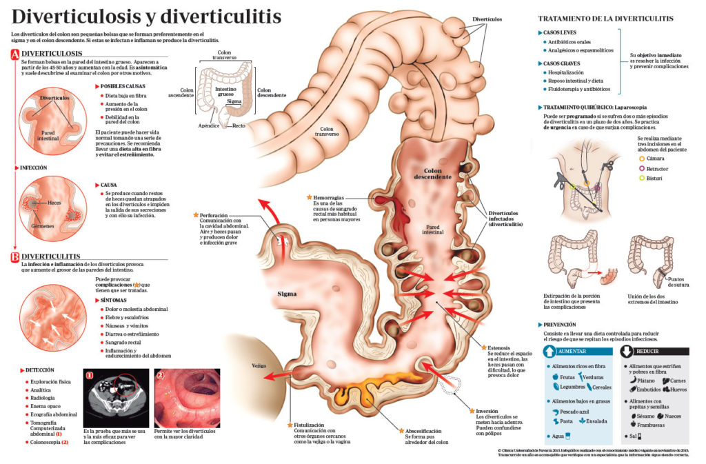 Дивертикулез кишечника: симптомы, диета и питание