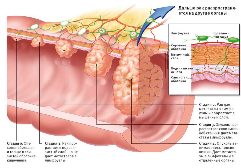 Раковая опухоль тонкого кишечника, симптомы, прогноз, лечение