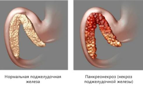 Панкреонекроз поджелудочной железы