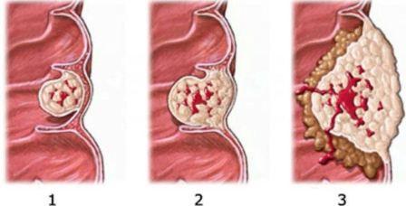 Симптомы рака толстой кишки и желудка thumbnail