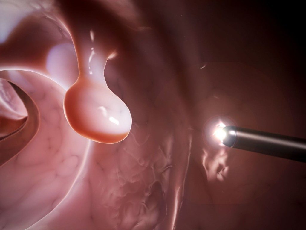 Виды и лечение полипов в кишечнике