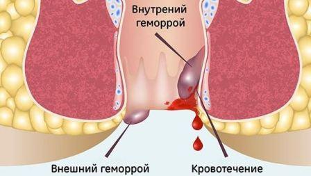 Причины появления крови в кале
