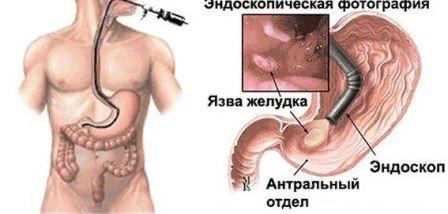 Исследование желудка и кишечника, гастроскопия