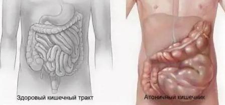 Как проявляется и лечится атония кишечника