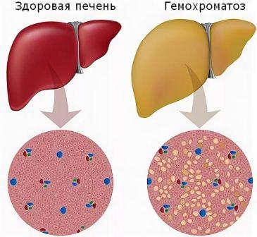 Причины развития и лечение гемохроматоза печени